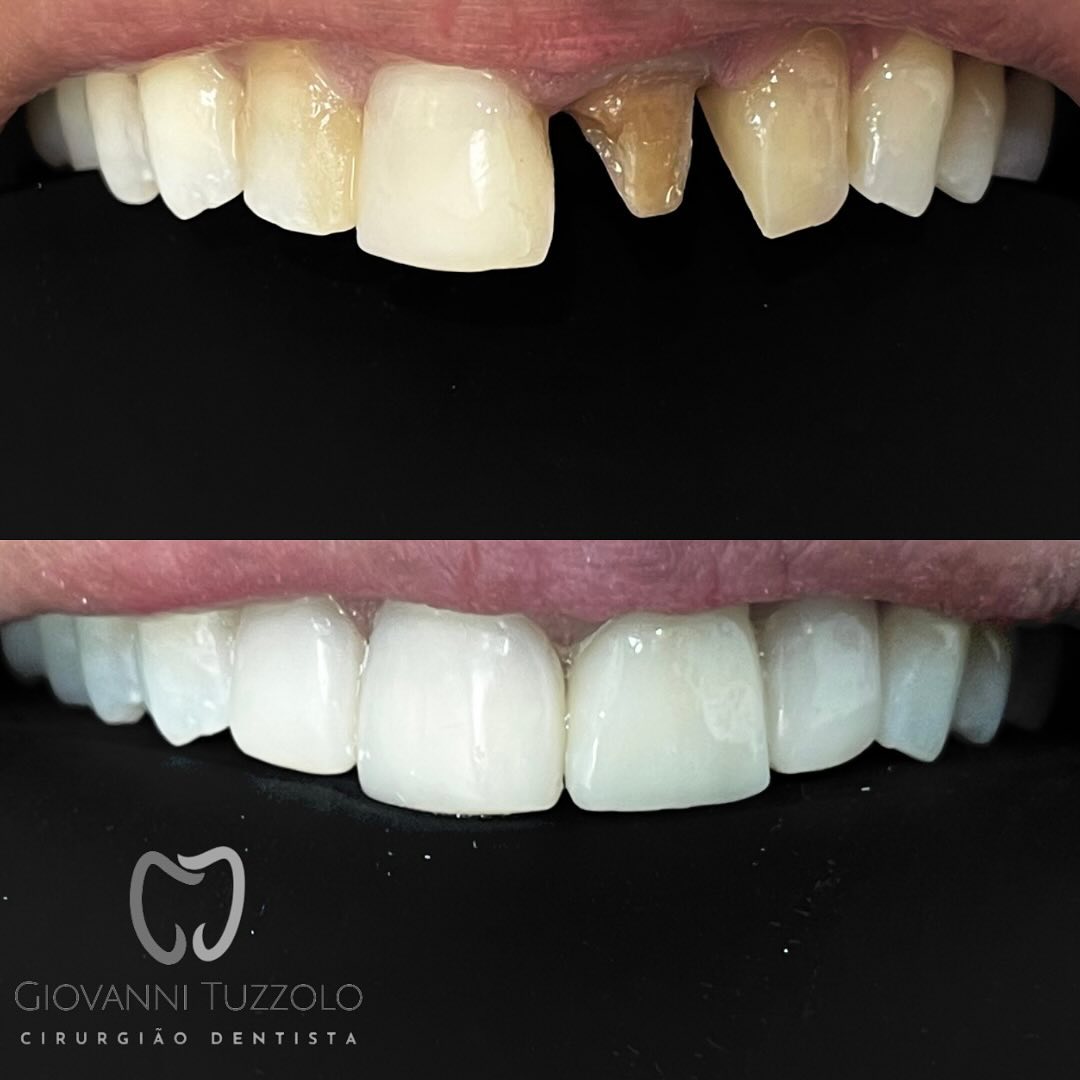 Restauração de dente fraturado — antes e depois